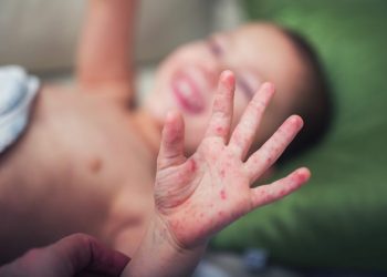 TP.HCM: Dịch sốt xuất huyết giảm, tay chân miệng tăng mạnh, sởi vẫn diễn biến phức tạp